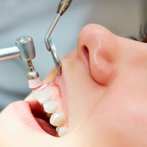 Limpeza Dental – Prevenção